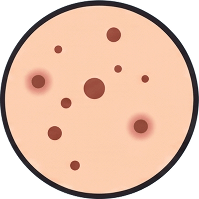 Acne Kit